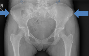 Traction apophysitis – rectus femoris (front of the hip joint)