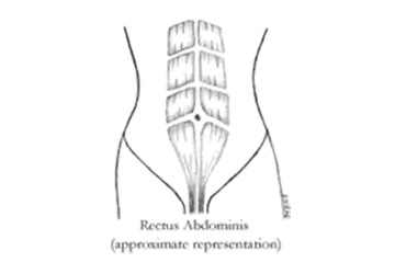 Diastasis Recti (DRAM) | PhysioActive Indonesia