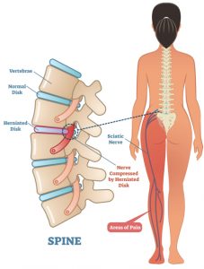 Pains associated with disc herniation