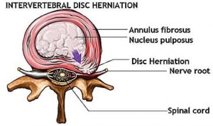 Invertebral Disc Herniation