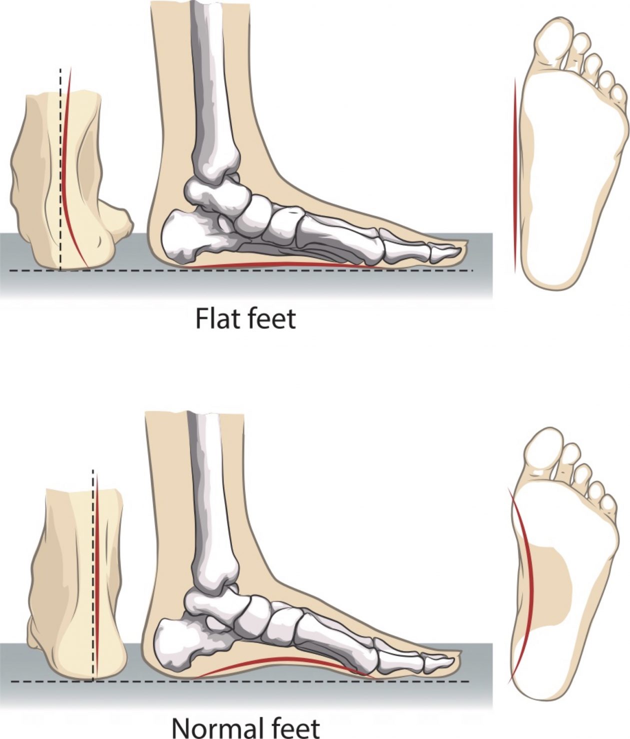 Singapore Surgeon Insights: Flatfeet - Dr K Kannan | PhysioActive Indonesia