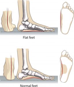 What does a flat foot look like