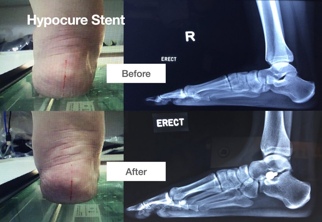 Hypocure Stent