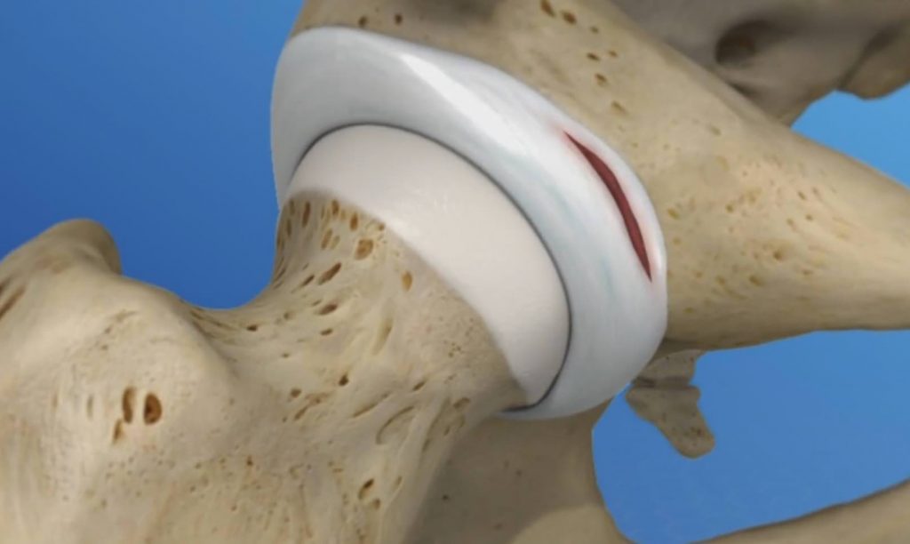 Labral Tear