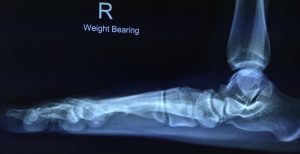 Weight baring X-ray