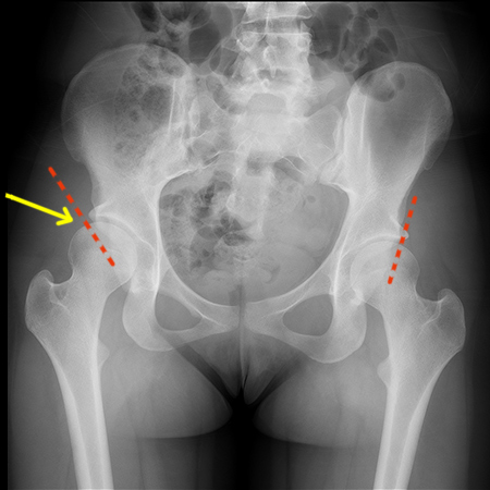 Hip Dysplasia