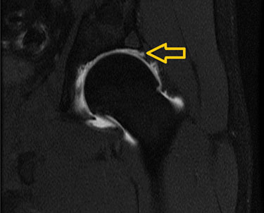 MRI of Labral Tear