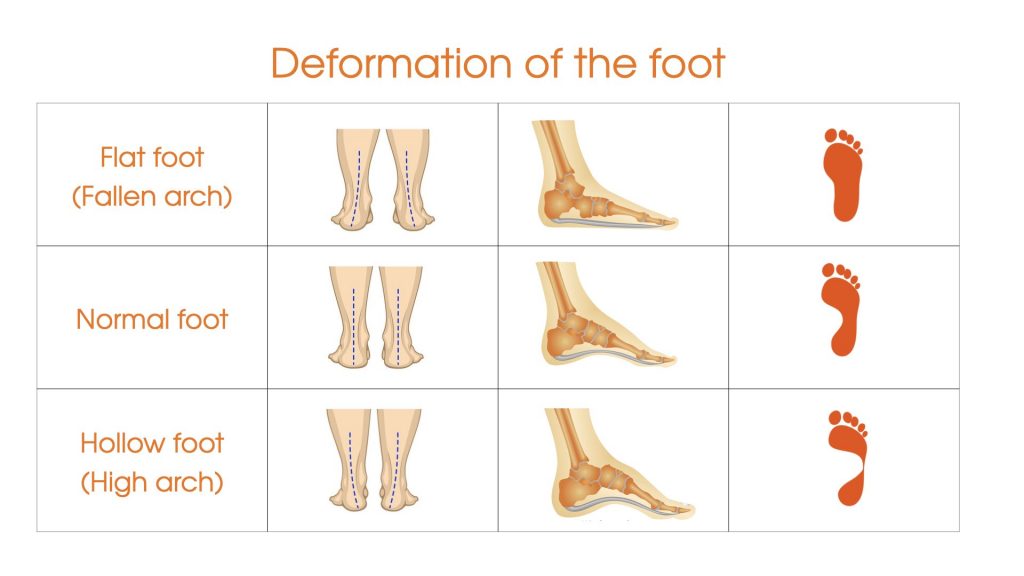 Deformation of the foot