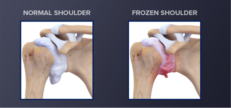 Frozen Shoulder