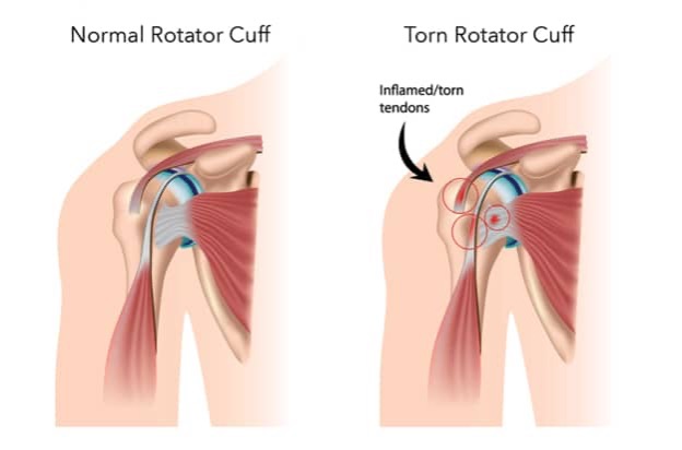 Rotator Cuff Injury