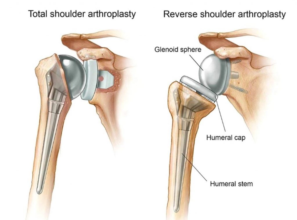 Reverse Shoulder Replacement