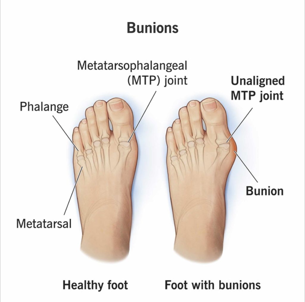 Bunion dan penyebabnya