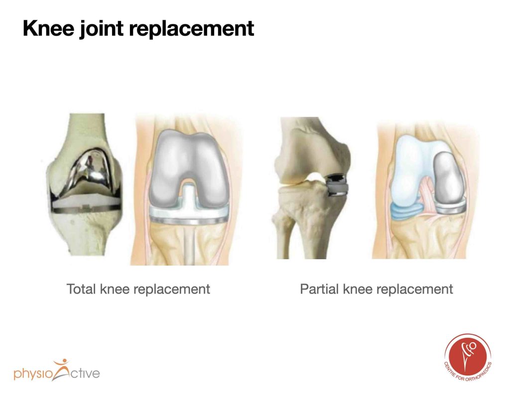 Knee Stages