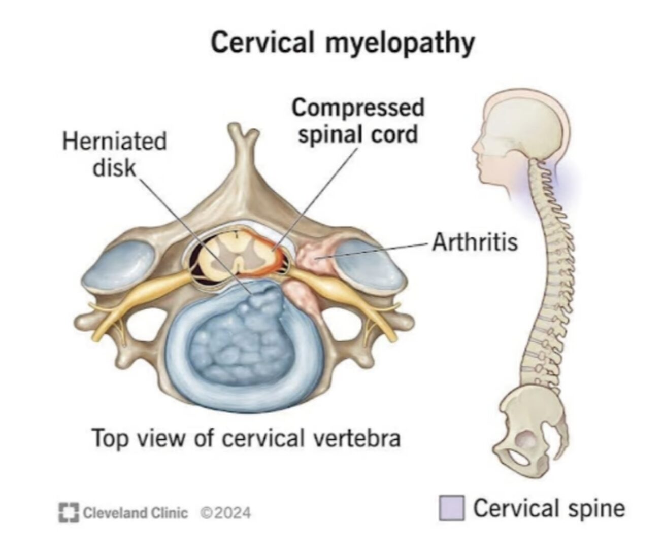 Cervical myelopathy diagram showing herniated disk, compressed spinal cord and arthritis — top view of cervical vertebra