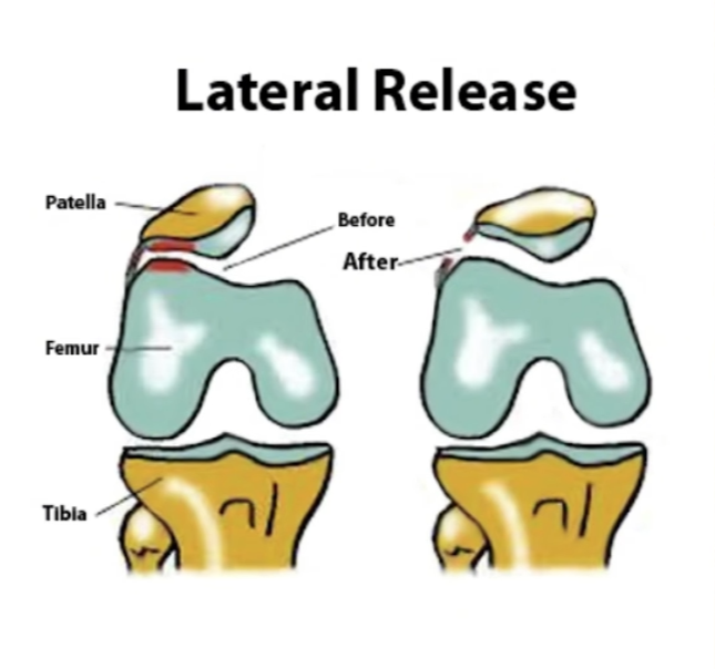 Risk factors for recurrent patella instability — ligamentous laxity showing hypermobile joints with higher range of motion