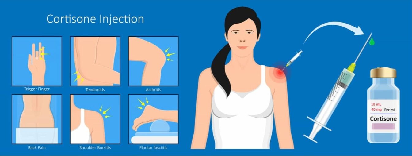 Cortisone injection treatment for sports injuries including trigger finger, tendonitis, arthritis, back pain, shoulder bursitis and plantar fasciitis