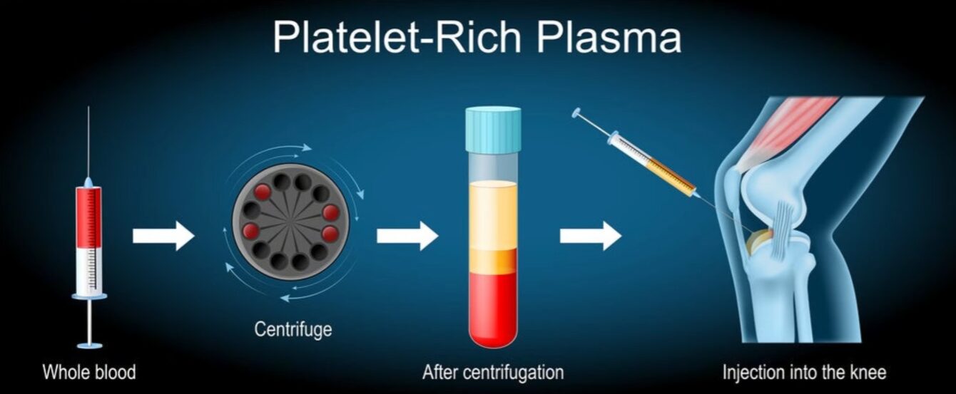 Platelet-rich plasma PRP injection process — whole blood drawn, centrifuged, and injected into the knee joint for sports injury healing